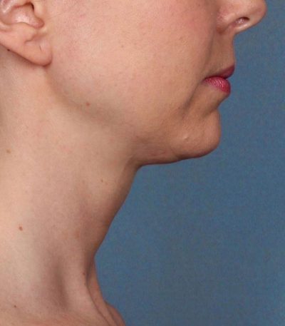kybella-after | KYBELLA | Buckhead Plastic Surgery - Northeast Atlanta