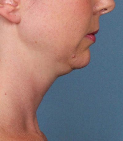 | KYBELLA | Buckhead Plastic Surgery - Northeast Atlanta