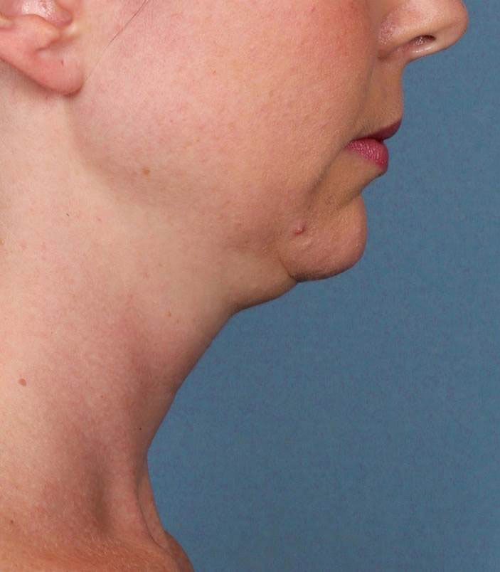 Kybella Injections for Double Chin Buckhead Plastic