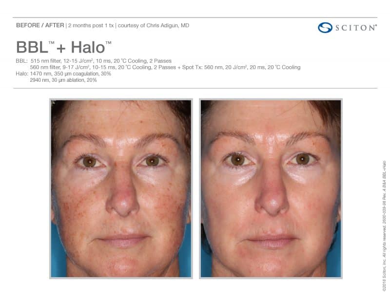 HALO Hybrid Fractional Laser | Buckhead Plastic Surgery