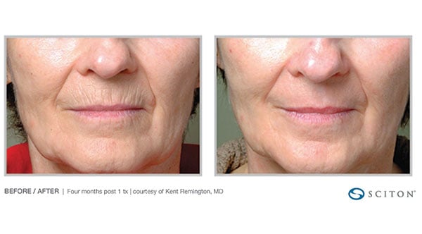 Deep Skin Resurfacing Contour TRL in San Diego Ca