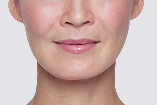 RESTYLANE LYFT experts in Atlanta, GA at Buckhead Plastic Surgery stop sagging skin & plump up hands and face treatment before and after photo