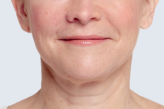 RESTYLANE LYFT experts in Atlanta, GA at Buckhead Plastic Surgery stop sagging skin & plump up hands and face treatment before and after photo