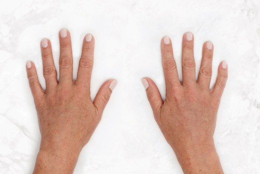 RESTYLANE LYFT experts in Atlanta, GA at Buckhead Plastic Surgery stop sagging skin & plump up hands and face treatment before and after photo