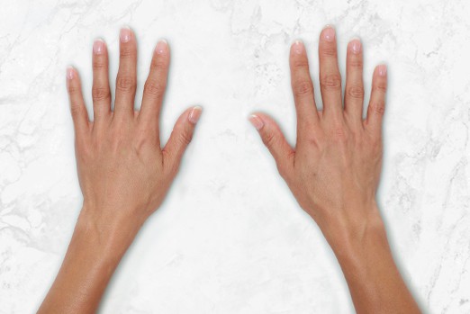 RESTYLANE LYFT experts in Atlanta, GA at Buckhead Plastic Surgery stop sagging skin & plump up hands and face treatment before and after photo