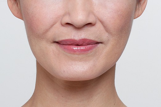 RESTYLANE LYFT experts in Atlanta, GA at Buckhead Plastic Surgery stop sagging skin & plump up hands and face treatment before and after photo