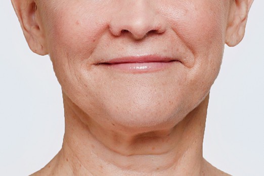 RESTYLANE LYFT experts in Atlanta, GA at Buckhead Plastic Surgery stop sagging skin & plump up hands and face treatment before and after photo