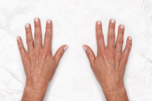 RESTYLANE LYFT experts in Atlanta, GA at Buckhead Plastic Surgery stop sagging skin & plump up hands and face treatment before and after photo