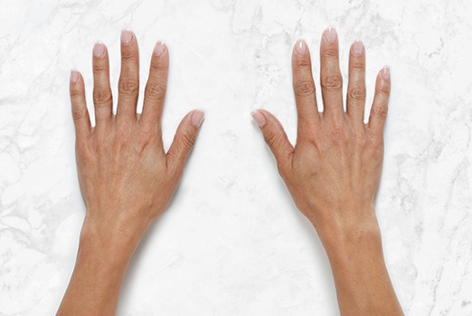 RESTYLANE LYFT experts in Atlanta, GA at Buckhead Plastic Surgery stop sagging skin & plump up hands and face treatment before and after photo