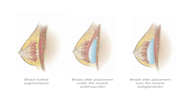 breast-augmentation-placement breast implants