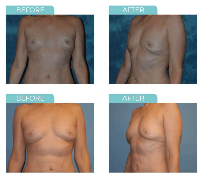 Implants vs. Fat Transfer: Buttock Augmentation Comparison