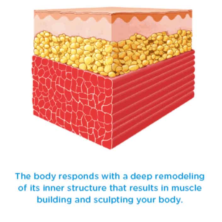EMSCULPT-3