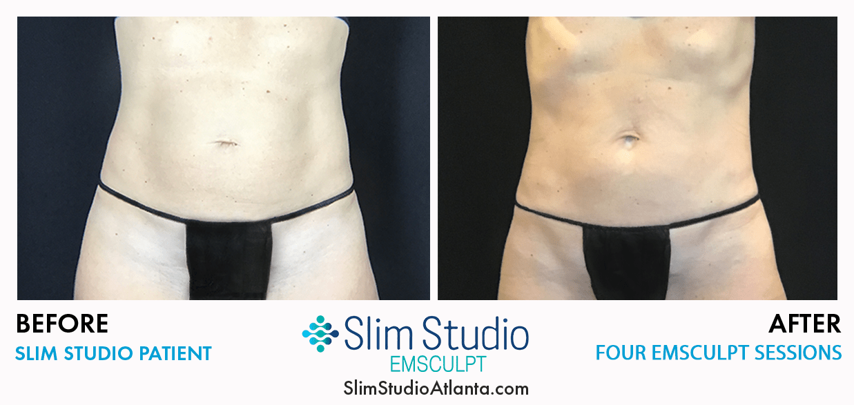 emscult-slim-studio-atlanta-patient-abdomen-results Slim Studio EMSCYLPT