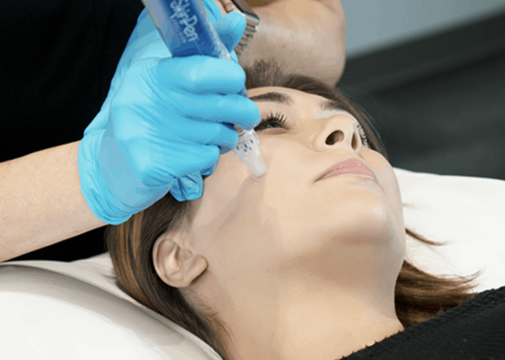 microneedling-at-lux-med-spa at buckhead plastic surgery