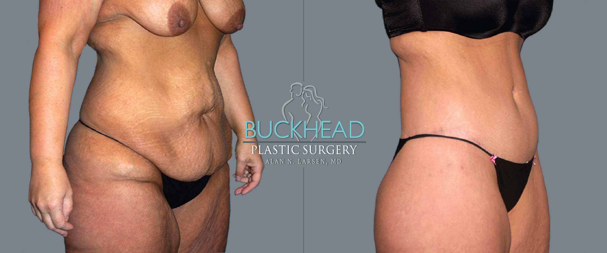 Before and After Photo gallery | Tummy Tuck | Buckhead Plastic Surgery | Double Board-Certified Plastic Surgeon in Atlanta GA
