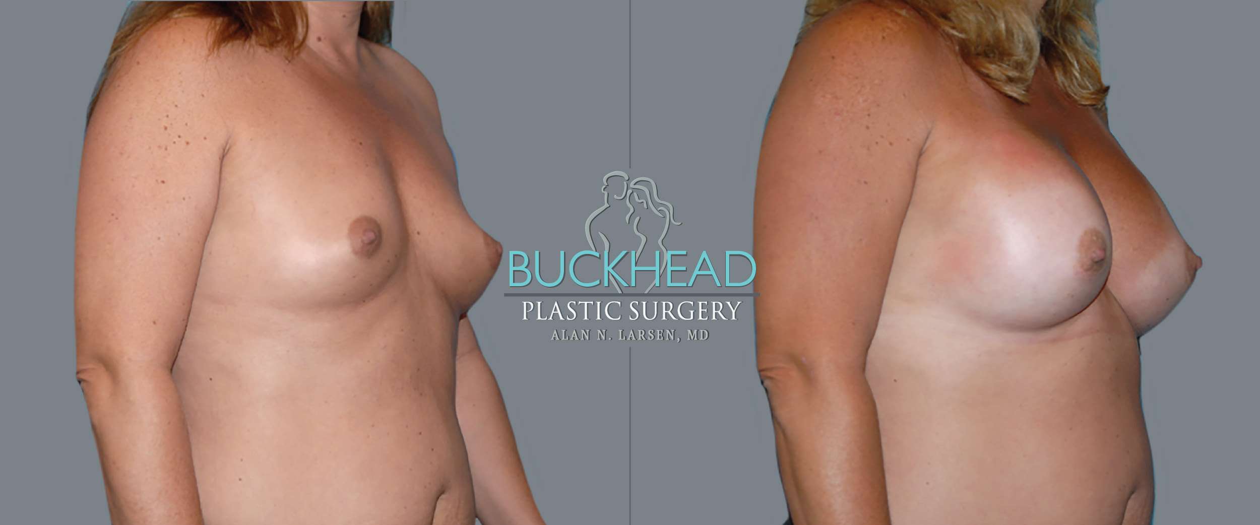 Before and After Photo gallery | Breast Augmentation | Buckhead Plastic Surgery | Double Board-Certified Plastic Surgeon in Atlanta GA