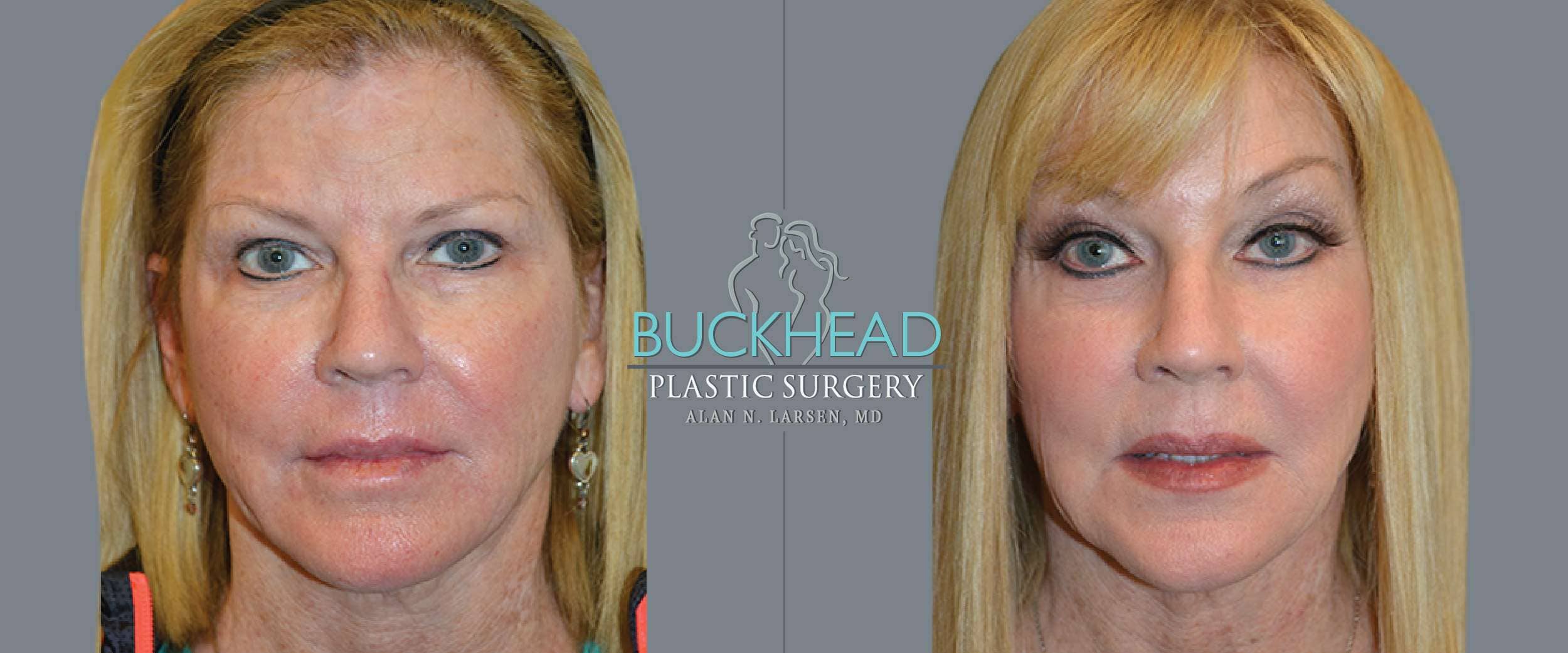 Before and After Photo Gallery | Blepharosty | Buckhead Plastic Surgery | Alan N. Larsen, MD | Double Board-Certified Plastic Surgeon | Atlanta GA
