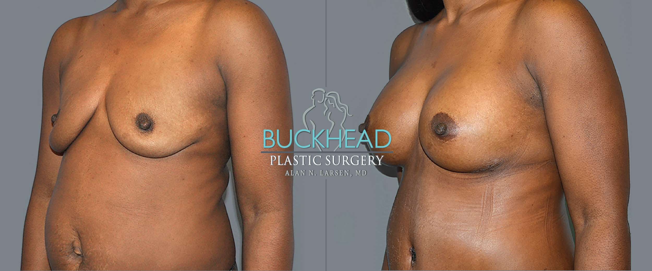 Before and After Photo gallery | Breast Augmentation | Buckhead Plastic Surgery | Double Board-Certified Plastic Surgeon in Atlanta GA