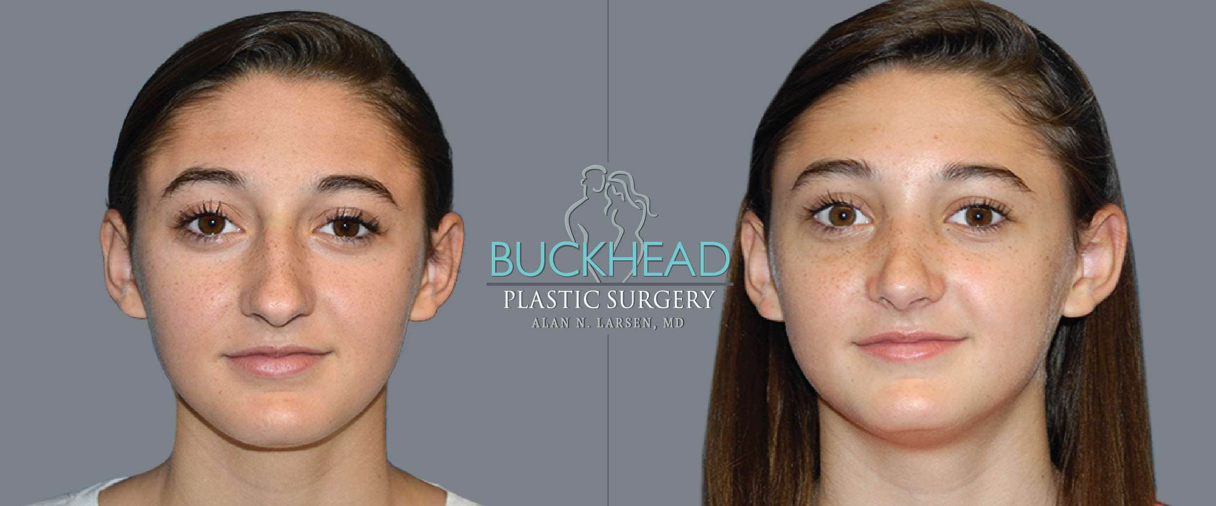 Before and After Photo gallery | Rhinoplasty | Buckhead Plastic Surgery | Double Board-Certified Plastic Surgeon in Atlanta GA