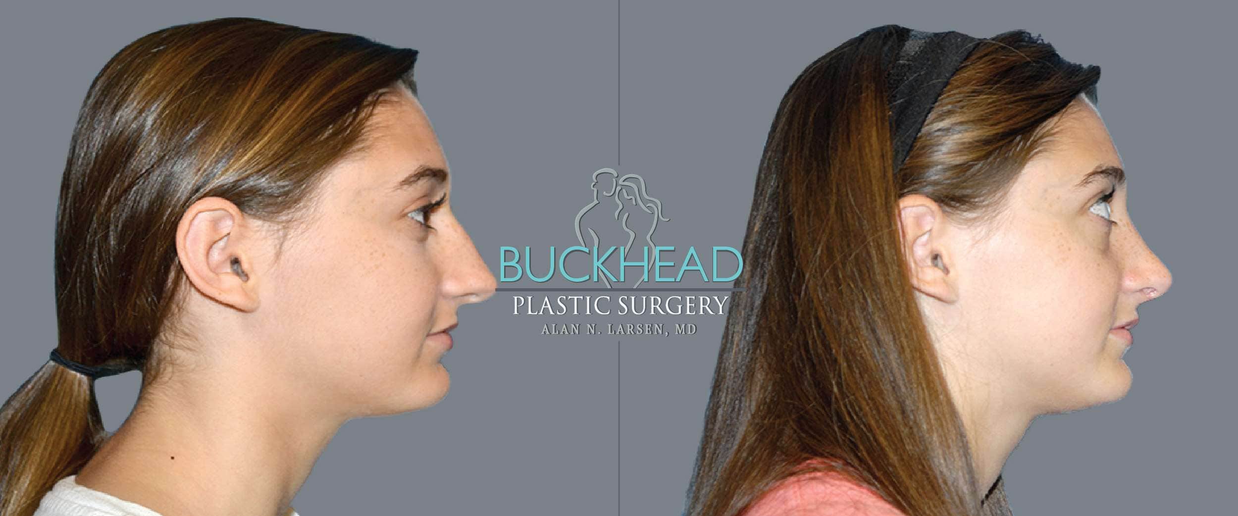 Before and After Photo gallery | Rhinoplasty | Buckhead Plastic Surgery | Double Board-Certified Plastic Surgeon in Atlanta GA
