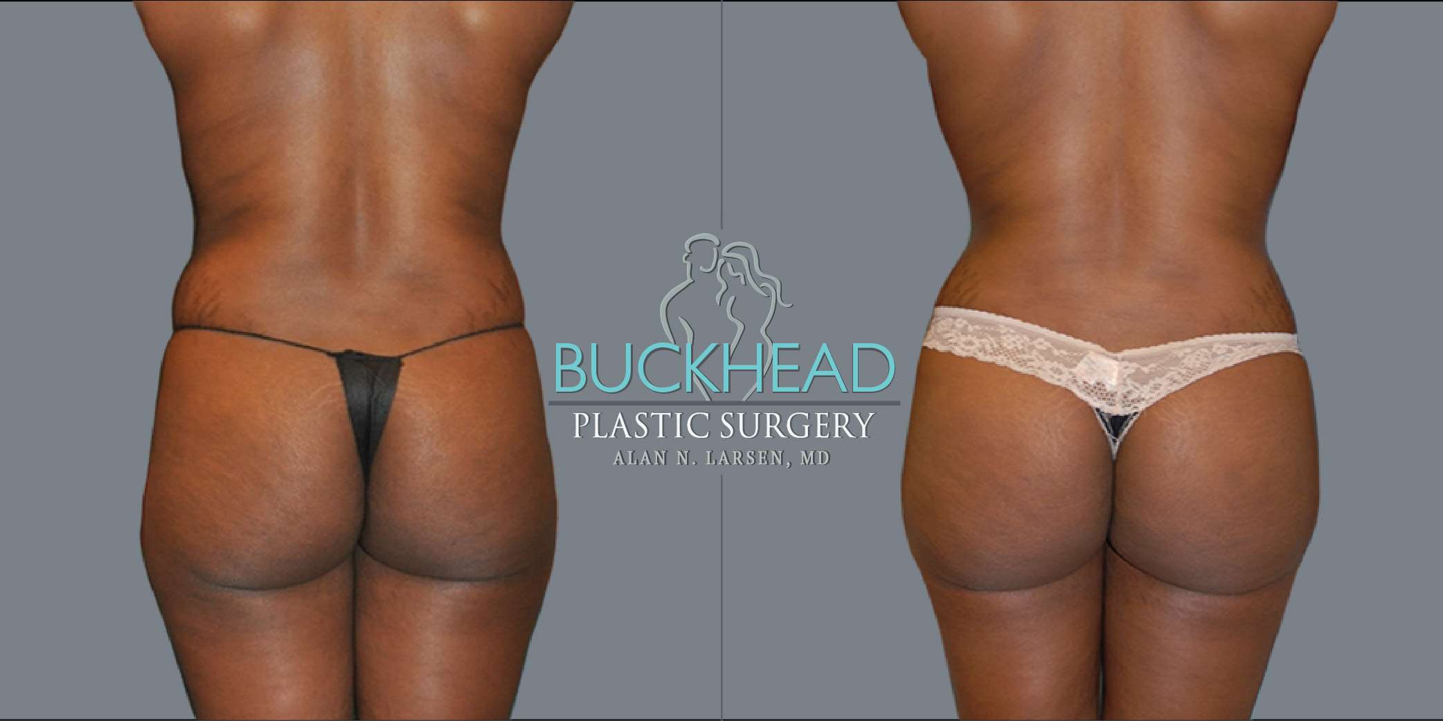 How to Recover Faster From Your Brazilian Butt Lift - Plastic Surgery in  Orlando, FL