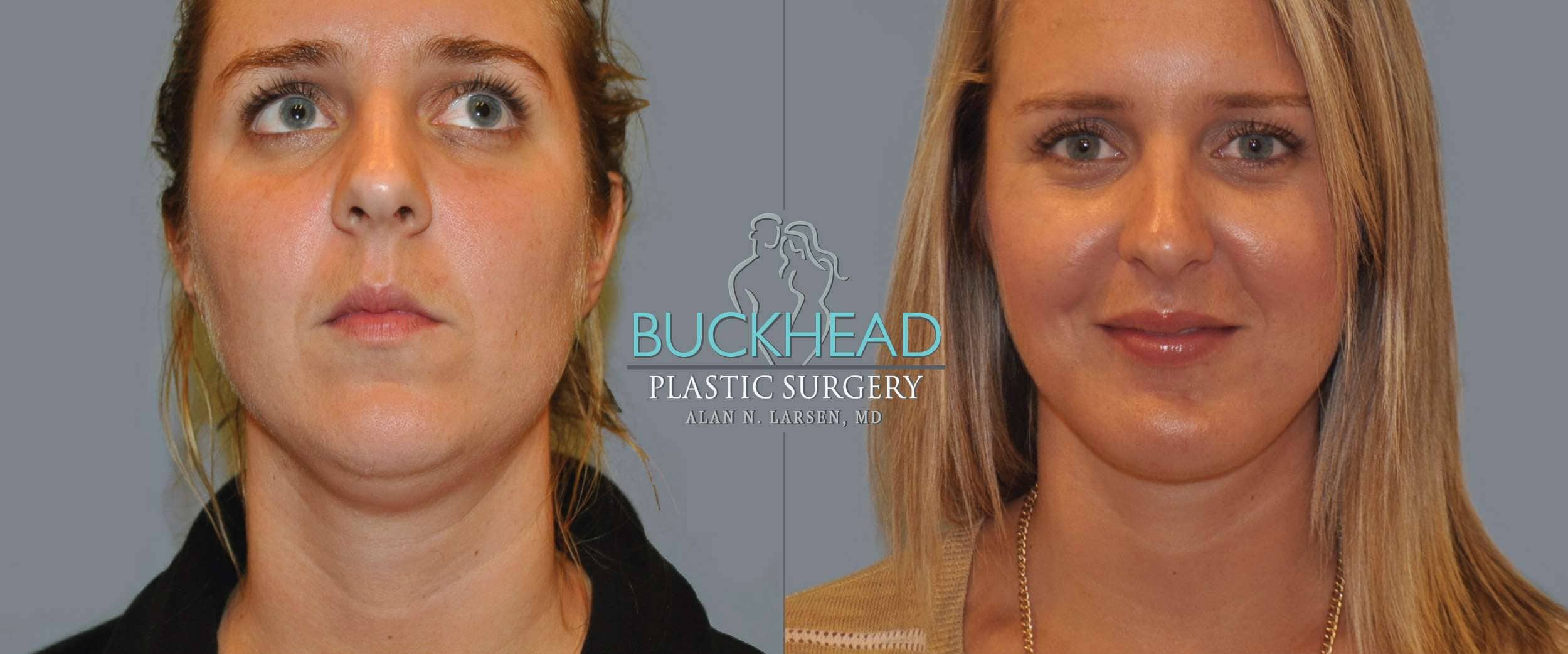 Before and After Photo Gallery | Liposuction - Neck | Buckhead Plastic Surgery | Alan N. Larsen, MD | Double Board-Certified Plastic Surgeon | Atlanta GA