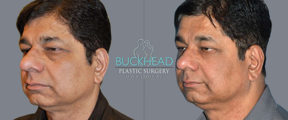 Surgery for Men | Buckhead Plastic Surgery | Atlanta GA