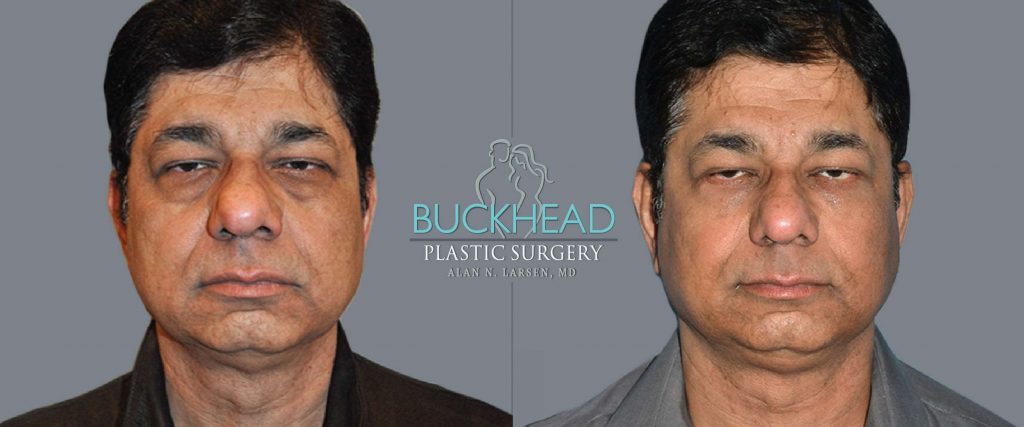Surgery for Men | Buckhead Plastic Surgery | Atlanta GA