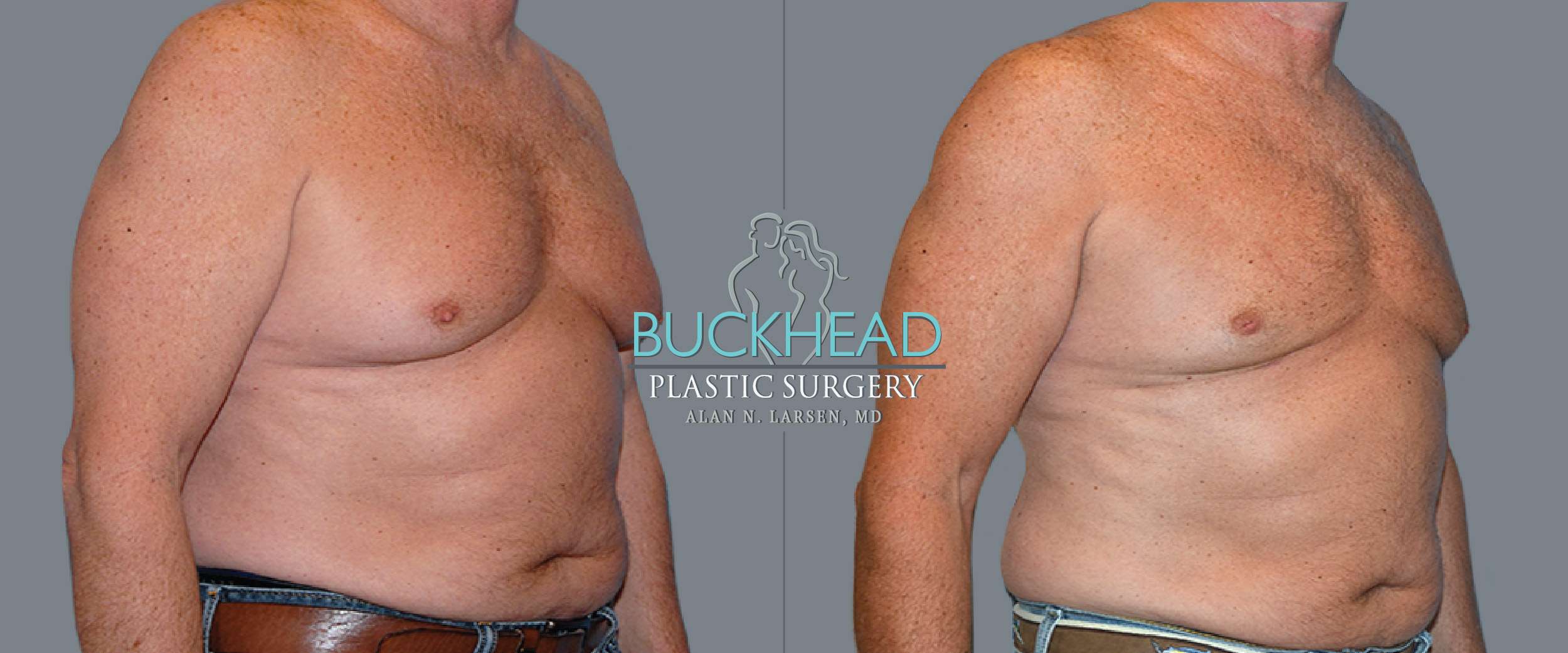 Before and After Photo Gallery | Gynecomastia - Male Breast Reduction & Correction | Buckhead Plastic Surgery | Double Board-Certified Plastic Surgeon in Atlanta GA