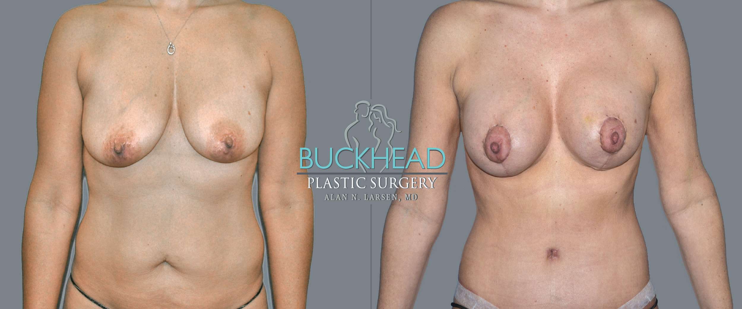Before and After Photo Gallery | Liposuction | Buckhead Plastic Surgery | Alan N. Larsen, MD | Double Board-Certified Plastic Surgeon | Atlanta GA