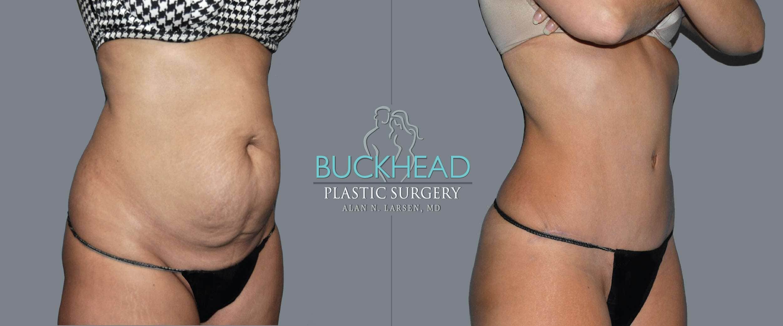 Before and After Photo Gallery | Liposuction - Hips & Flanks | Buckhead Plastic Surgery | Alan N. Larsen, MD | Double Board-Certified Plastic Surgeon | Atlanta GA