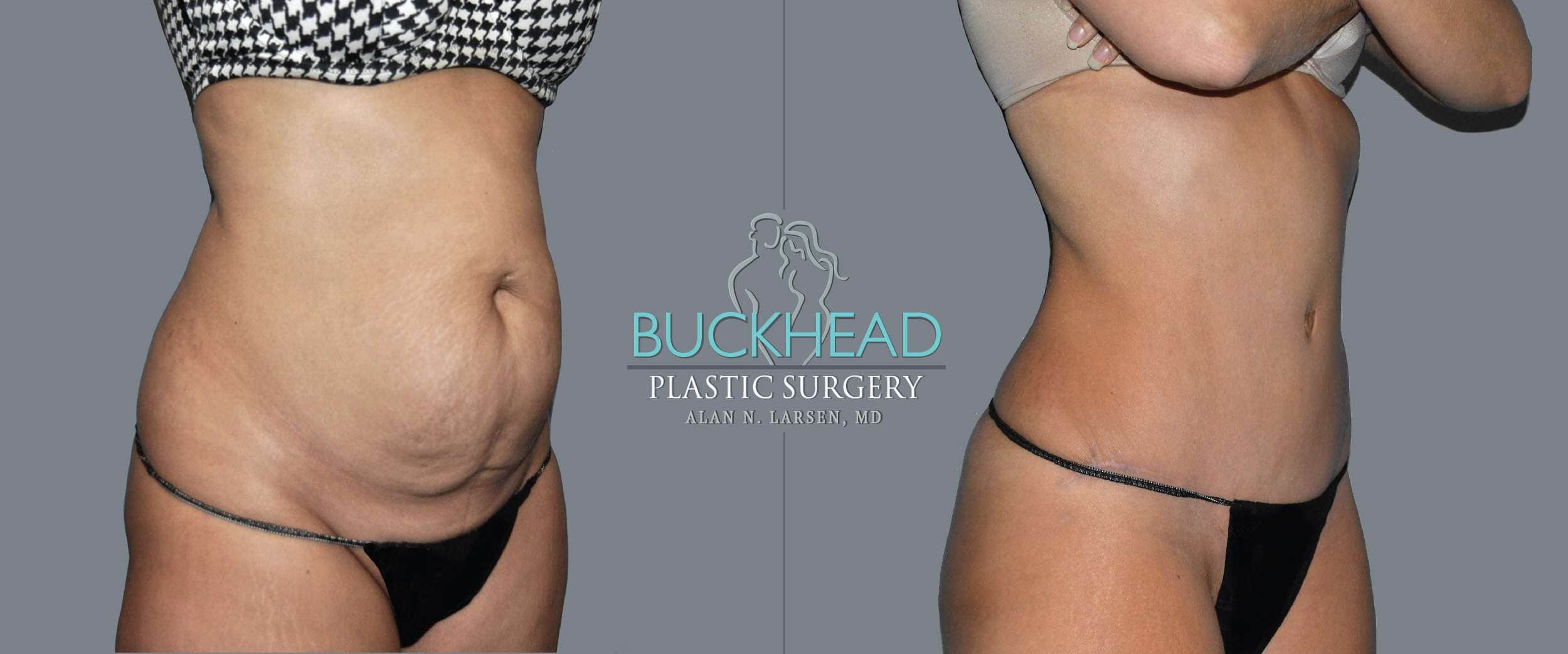 5 Things to Know About Stomach Liposuction, In Atlanta