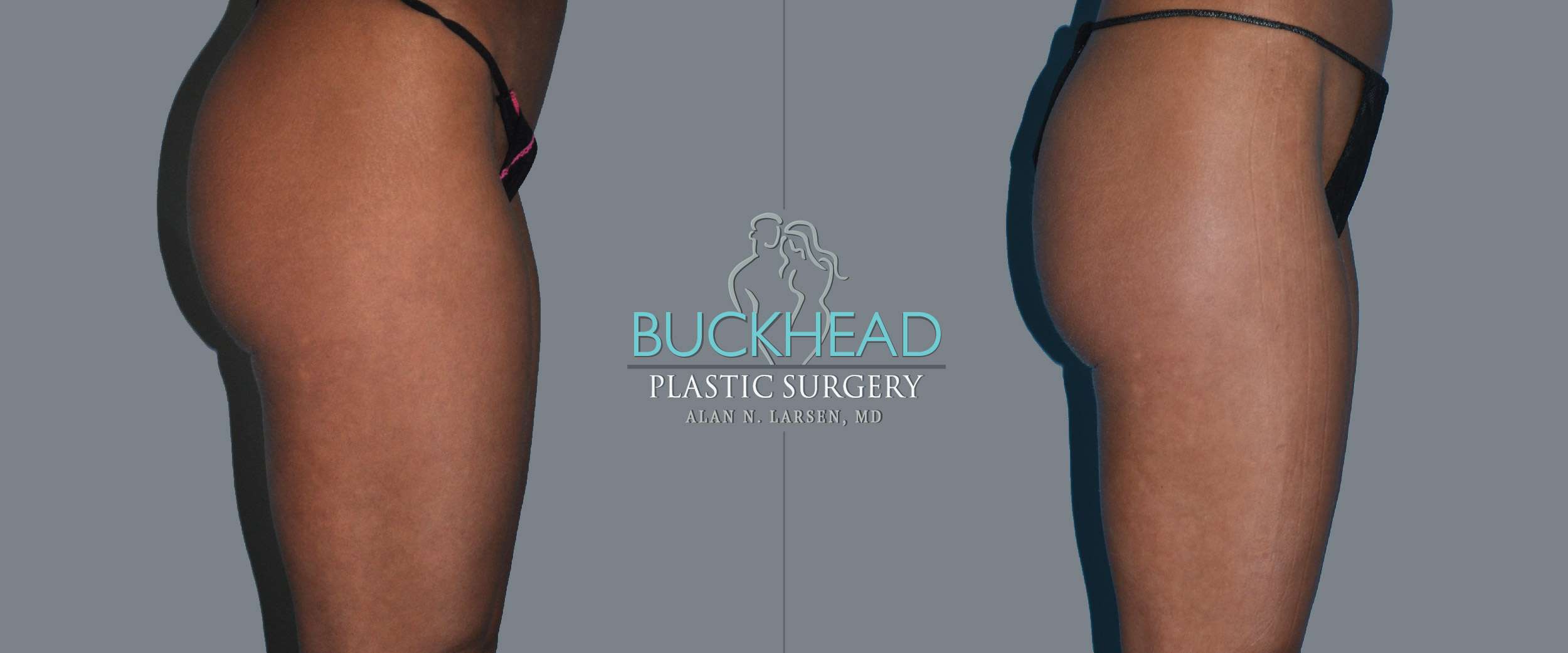 Before and After Photo Gallery | Liposuction - Thigh Back | Buckhead Plastic Surgery | Alan N. Larsen, MD | Double Board-Certified Plastic Surgeon | Atlanta GA