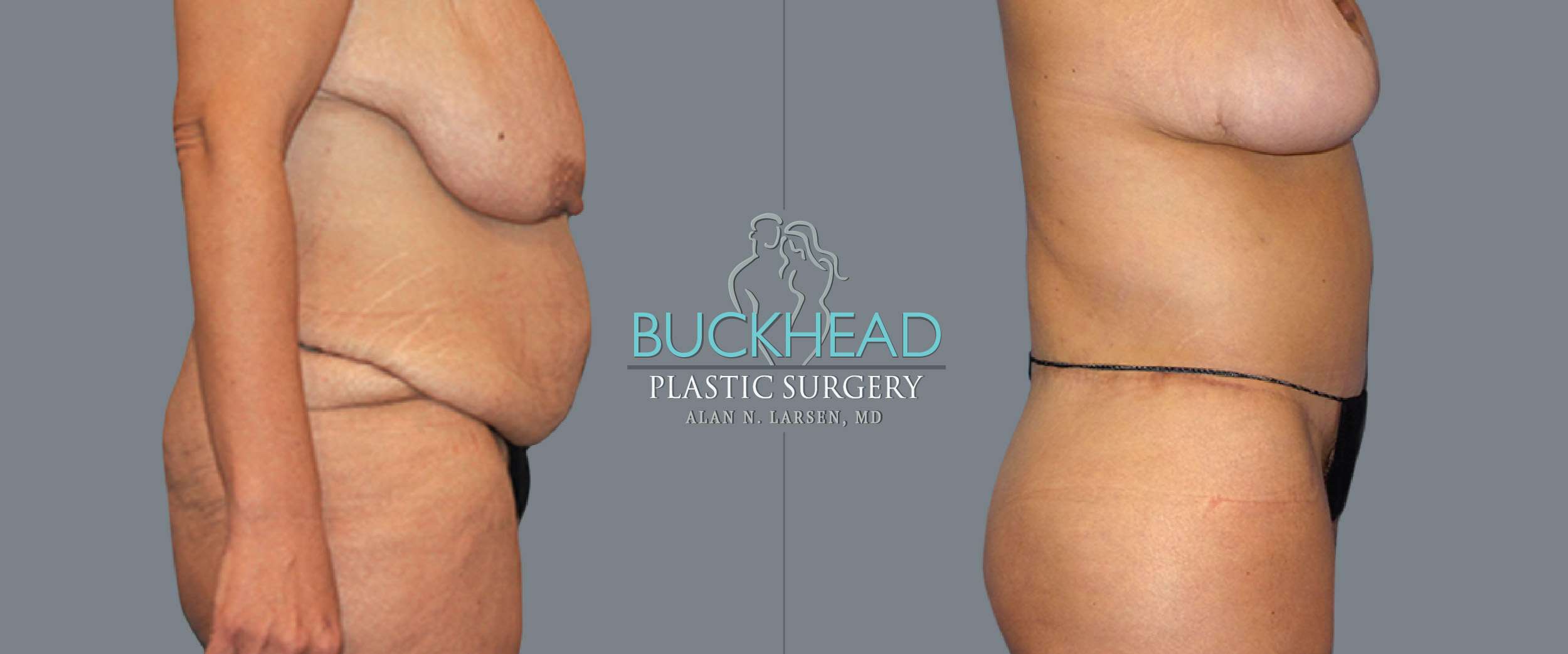 Before and After Photo gallery | Body Lift | Buckhead Plastic Surgery | Double Board-Certified Plastic Surgeon in Atlanta GA