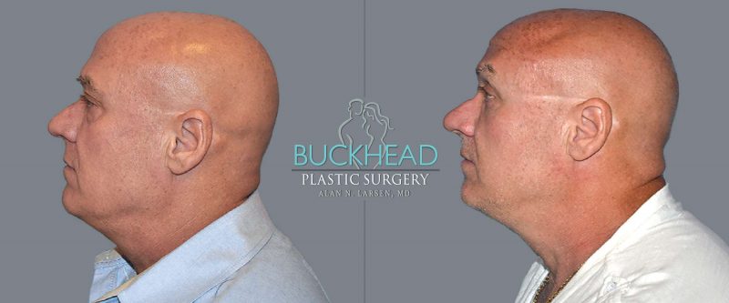 Surgery for Men | Buckhead Plastic Surgery | Atlanta GA