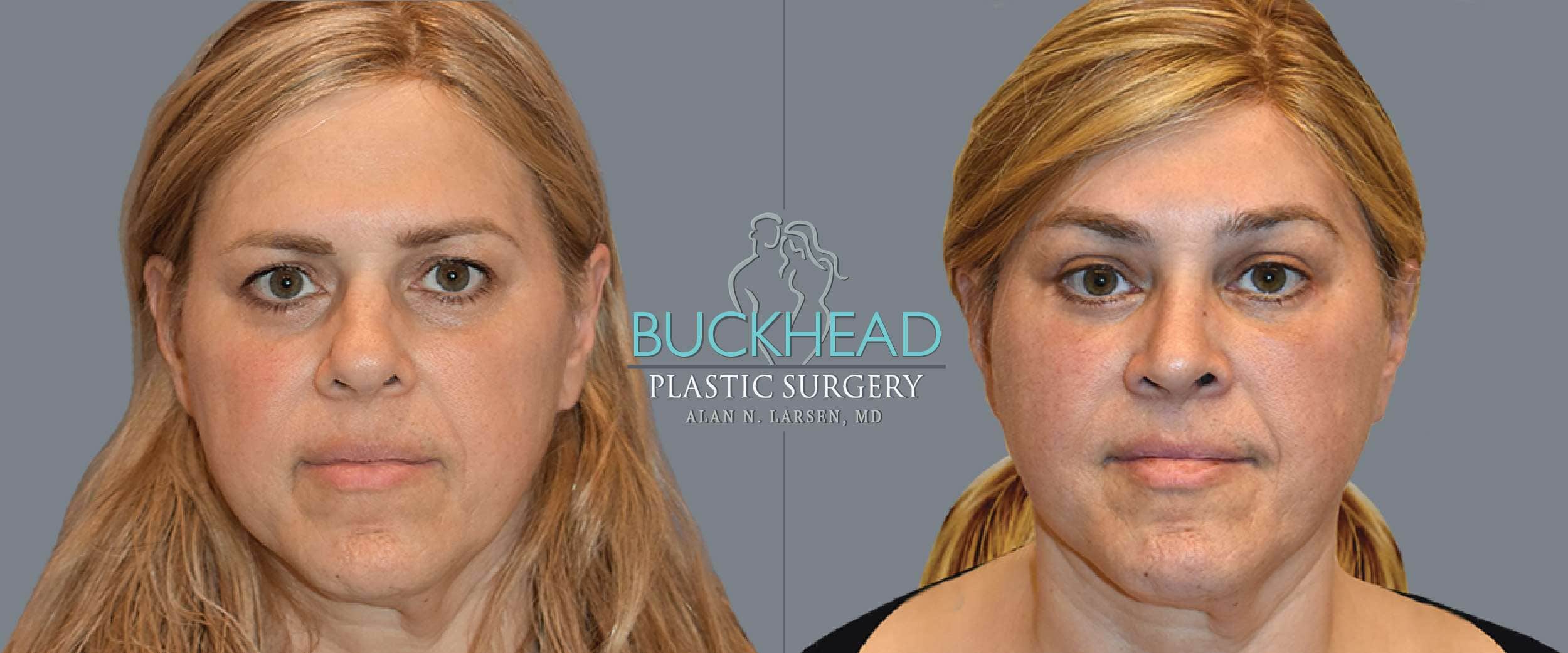 Before and After Photo Gallery | Blepharosty | Buckhead Plastic Surgery | Alan N. Larsen, MD | Double Board-Certified Plastic Surgeon | Atlanta GA