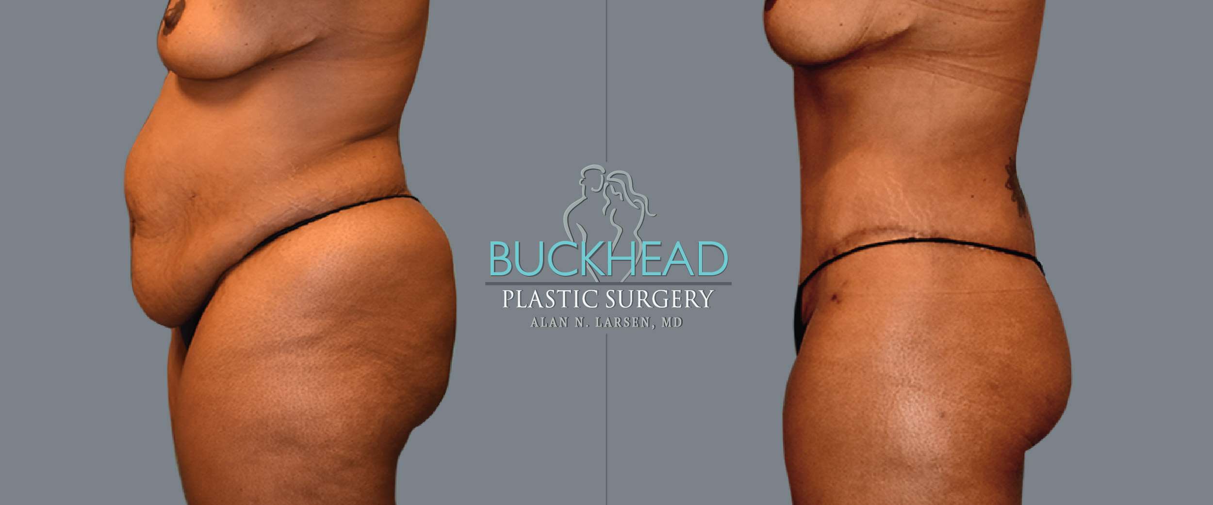 Before and After Photo gallery | Body Lift | Buckhead Plastic Surgery | Double Board-Certified Plastic Surgeon in Atlanta GA