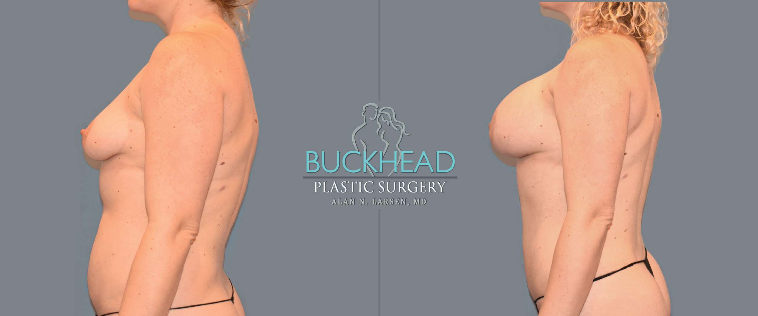 Before and After Photo Gallery | Liposuction | Buckhead Plastic Surgery | Alan N. Larsen, MD | Double Board-Certified Plastic Surgeon | Atlanta GA