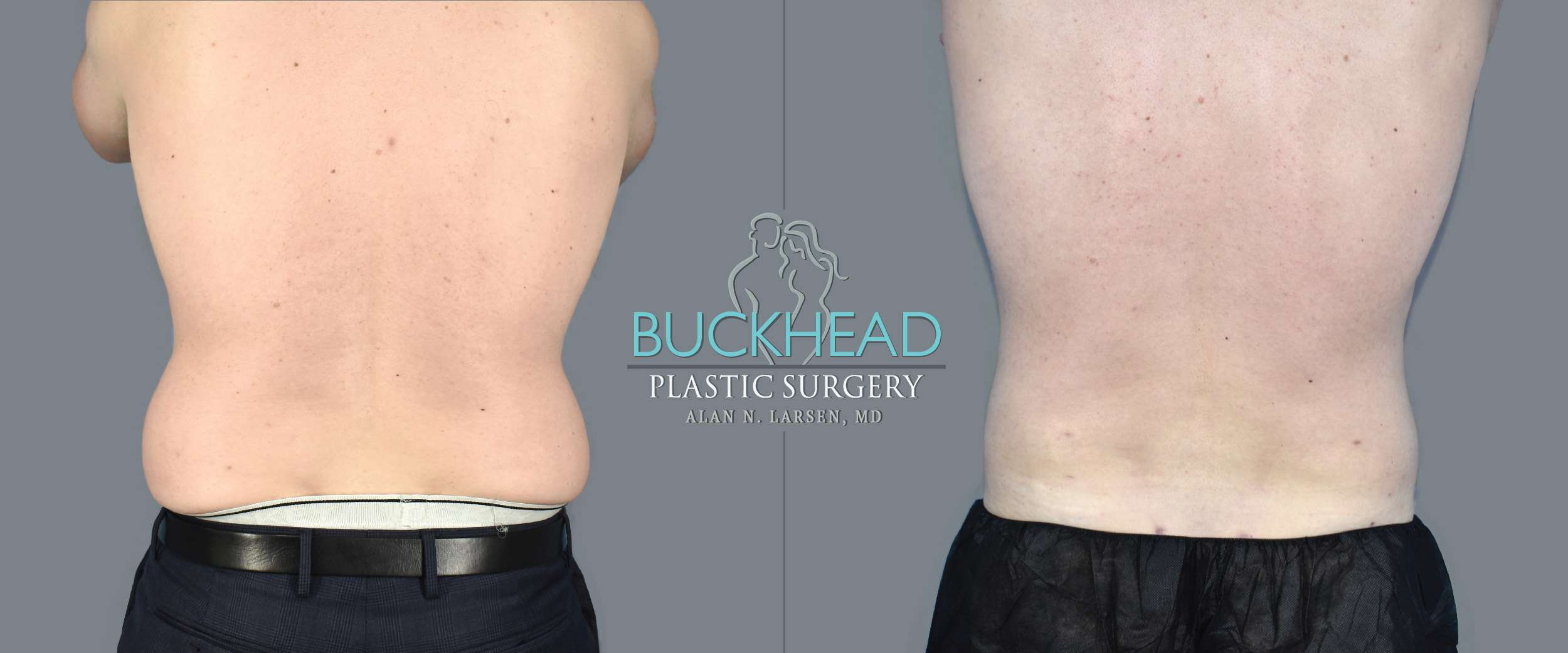 Before and After Photo Gallery | Liposuction | Buckhead Plastic Surgery | Alan N. Larsen, MD | Double Board-Certified Plastic Surgeon | Atlanta GA