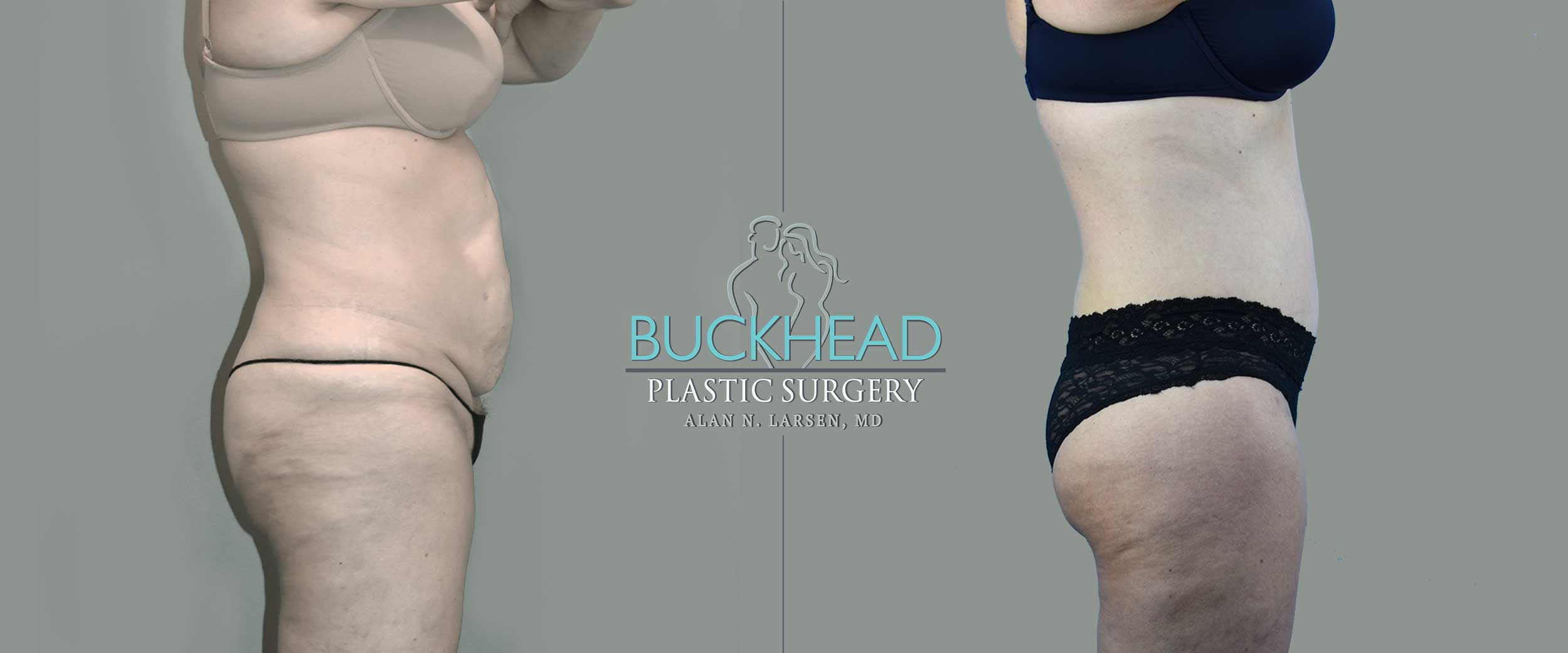 Why Should I Choose Buckhead Plastic Surgery for My Body Lift or Mommy Makeover?