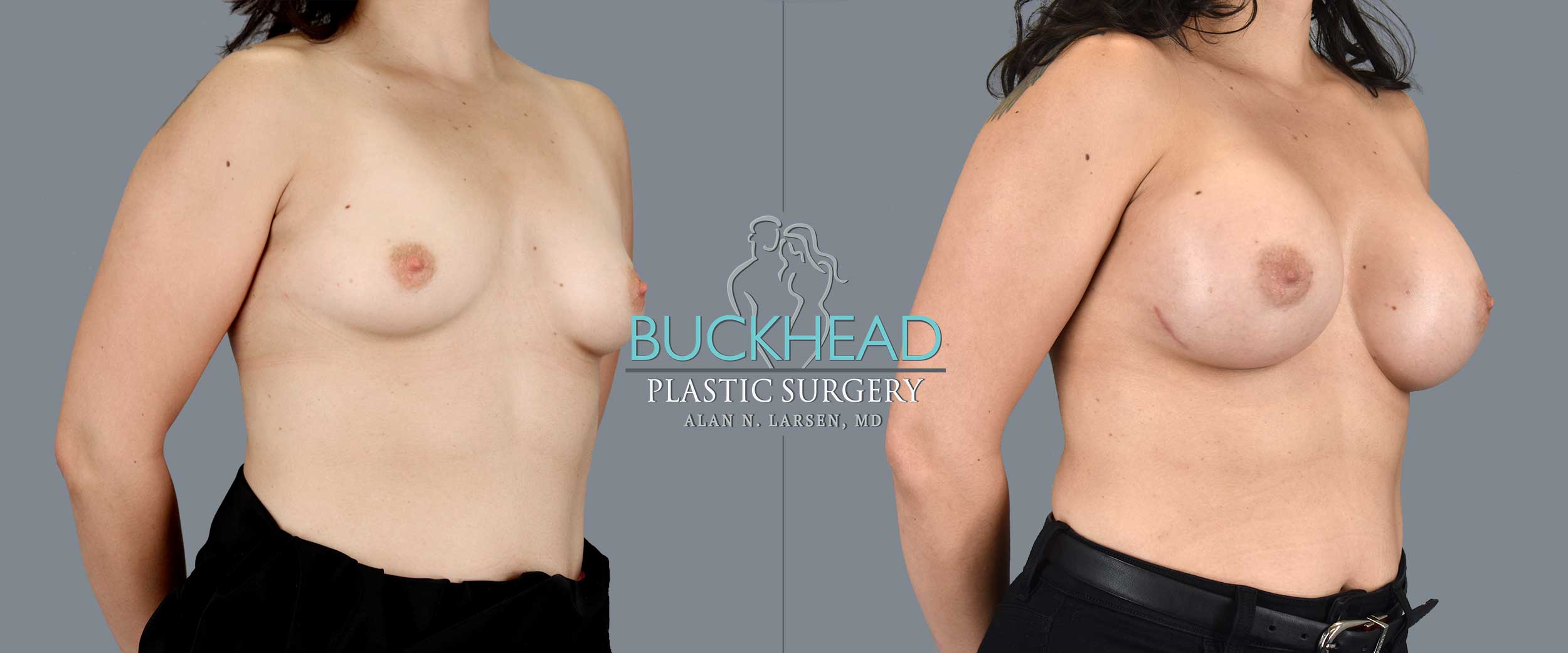 Before and After Photo Gallery | Breast Aug | Buckhead Plastic Surgery | Alan N. Larsen, MD | Board-Certified Plastic Surgeon | Atlanta GA