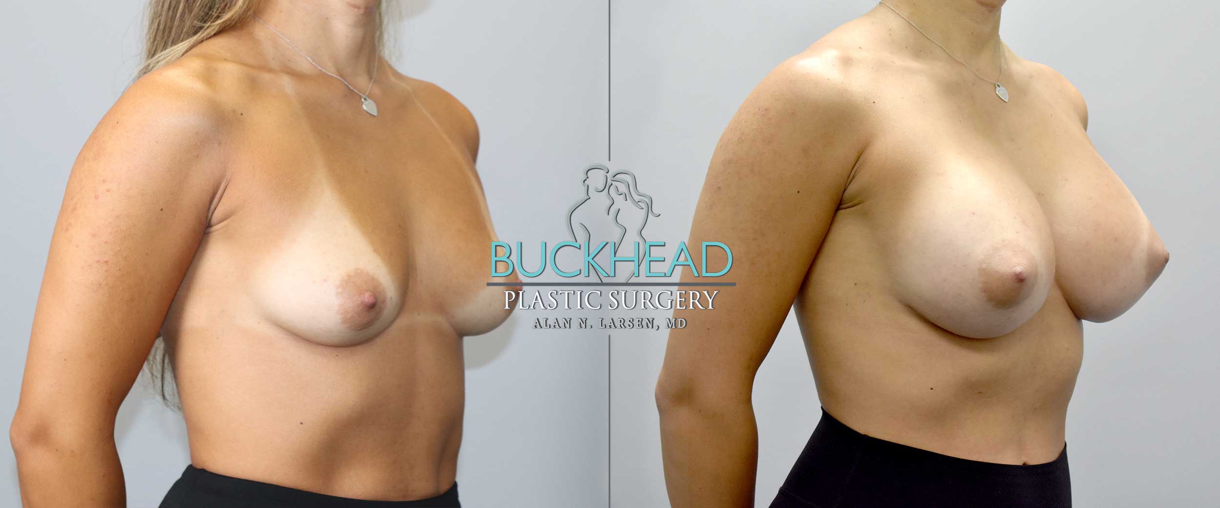 Why Should I Choose Buckhead Plastic Surgery for My Body Lift or Mommy Makeover?