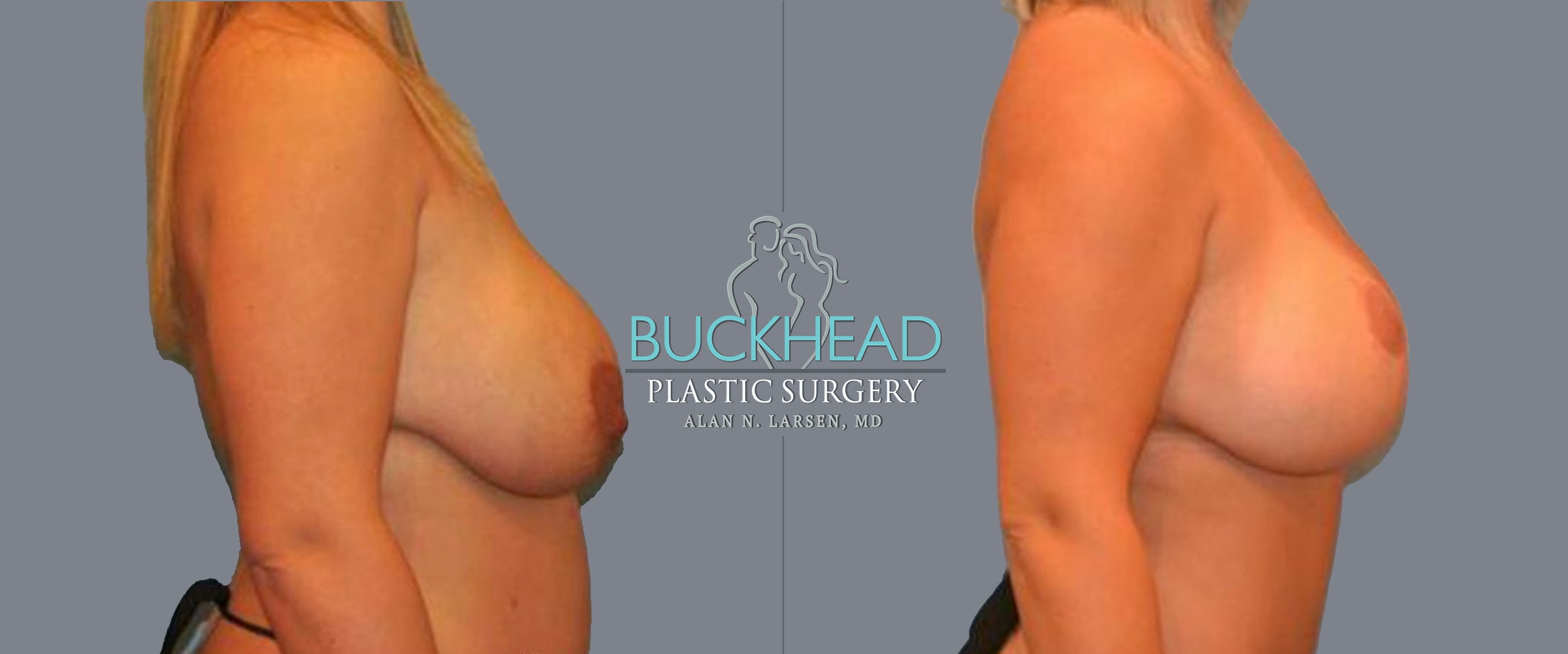 Before and After Photo Gallery | Breast Lift | Buckhead Plastic Surgery | Alan N. Larsen, MD | Board-Certified Plastic Surgeon | Atlanta GA