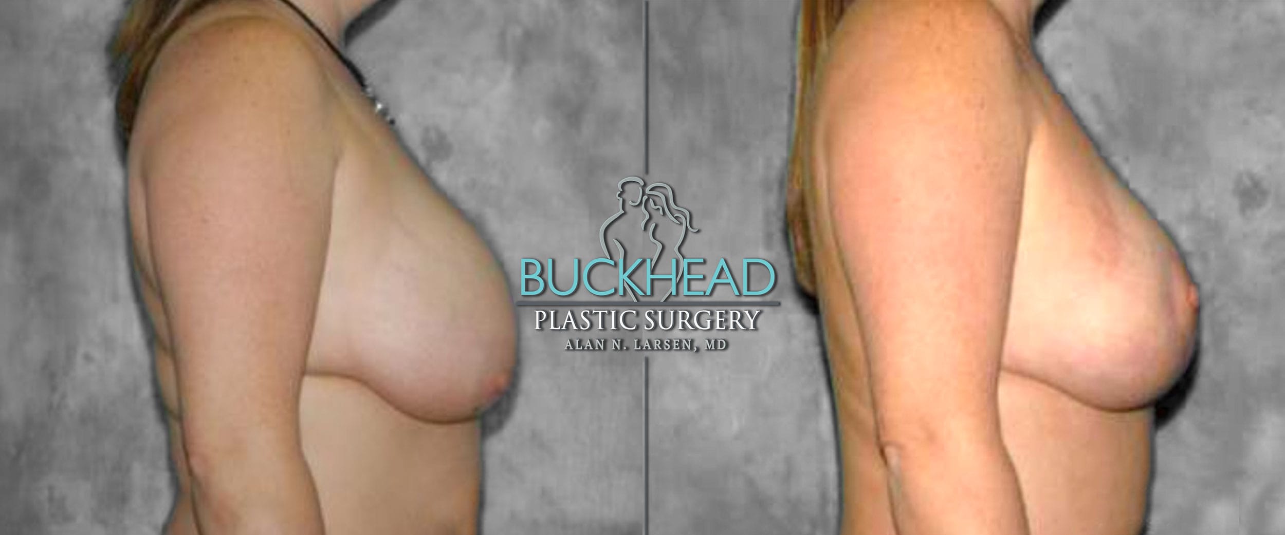 Before and After Photo Gallery | Breast Lift | Buckhead Plastic Surgery | Alan N. Larsen, MD | Double Board-Certified Plastic Surgeon | Atlanta GA