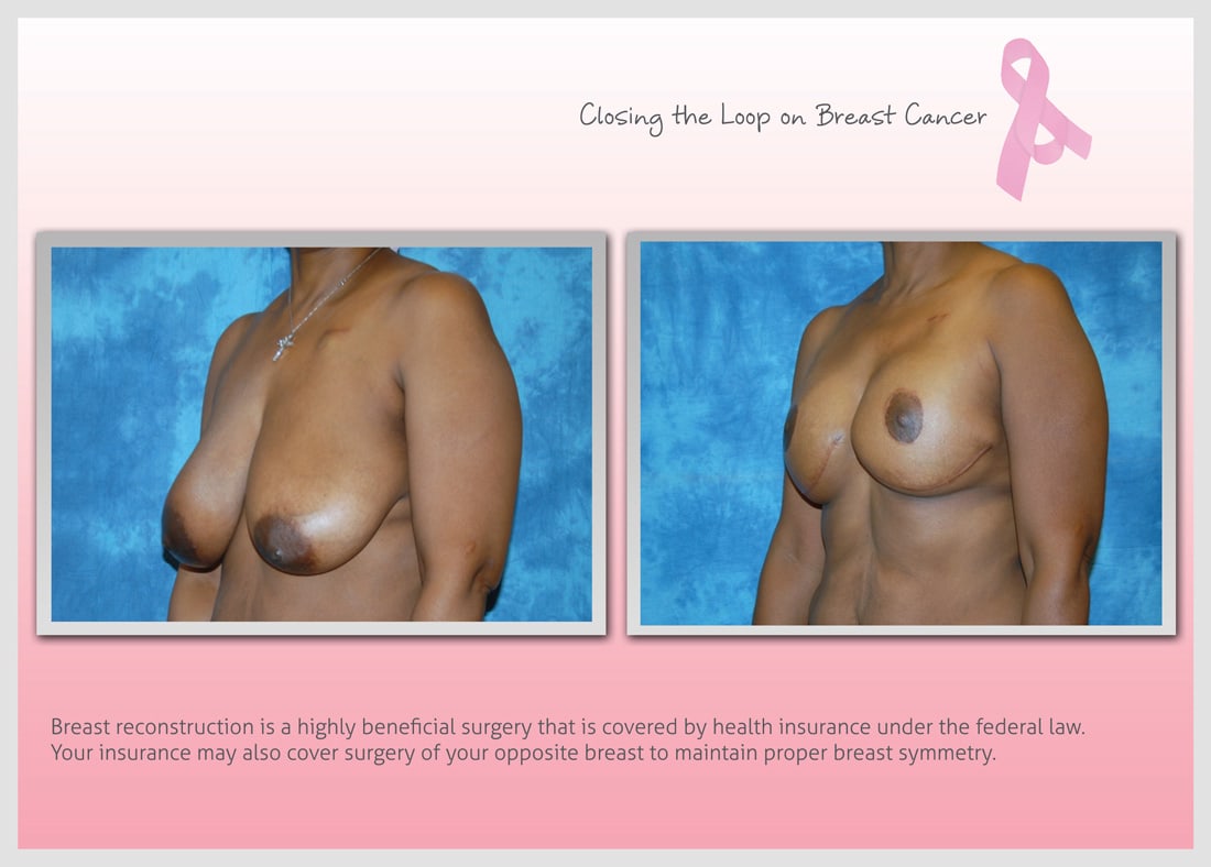 Before and After Photo Gallery | Breast Reconstruction | Buckhead Plastic Surgery | Alan N. Larsen, MD | Board-Certified Plastic Surgeon | Atlanta GA