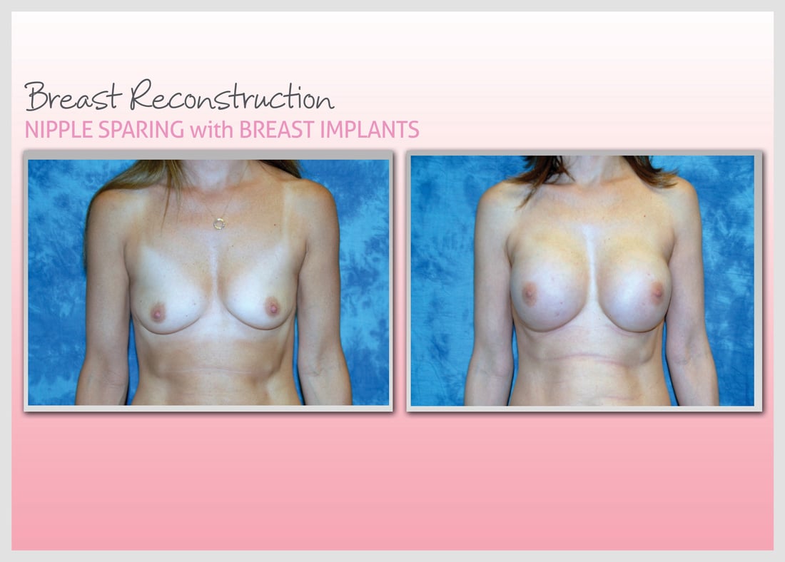 Before and After Photo Gallery | Breast Reconstruction | Buckhead Plastic Surgery | Alan N. Larsen, MD | Board-Certified Plastic Surgeon | Atlanta GA