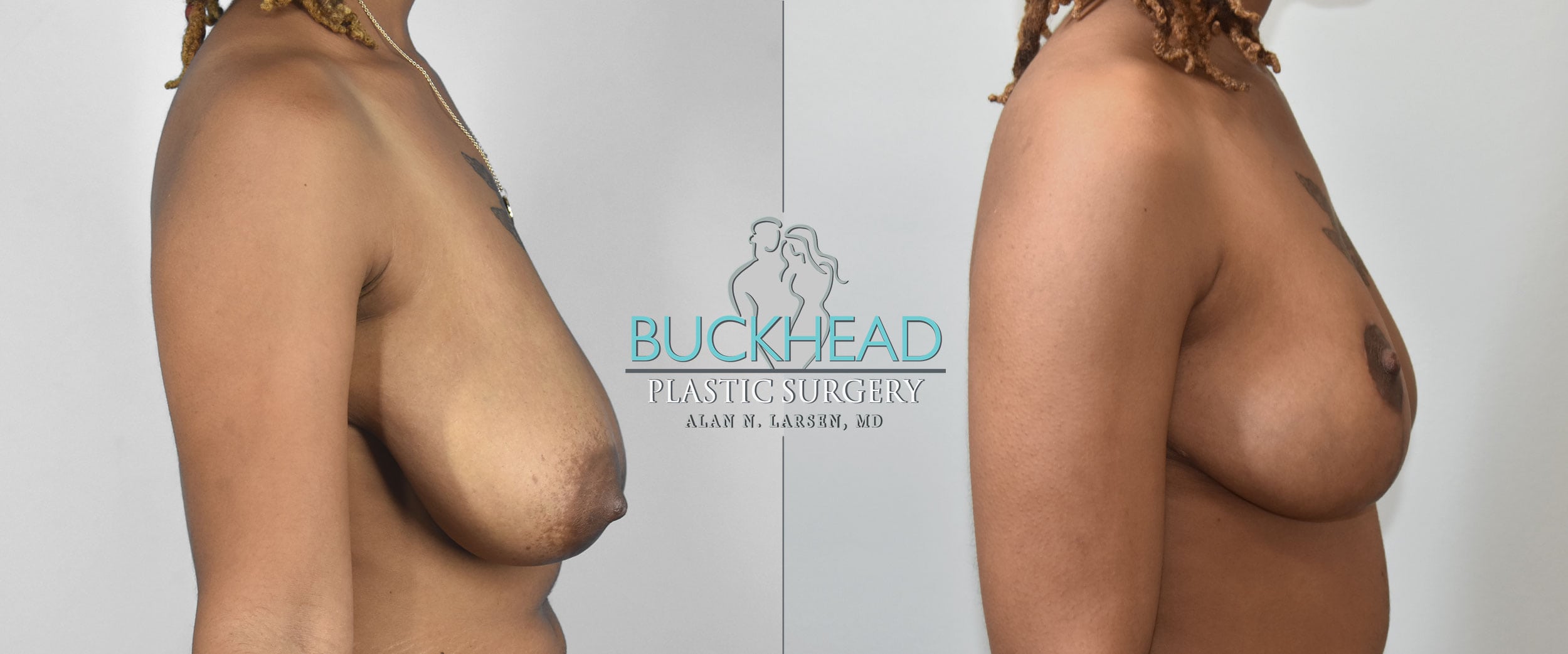 Before and After Photo Gallery | Breast Reduction | Buckhead Plastic Surgery | Alan N. Larsen, MD | Double Board-Certified Plastic Surgeon | Atlanta GA
