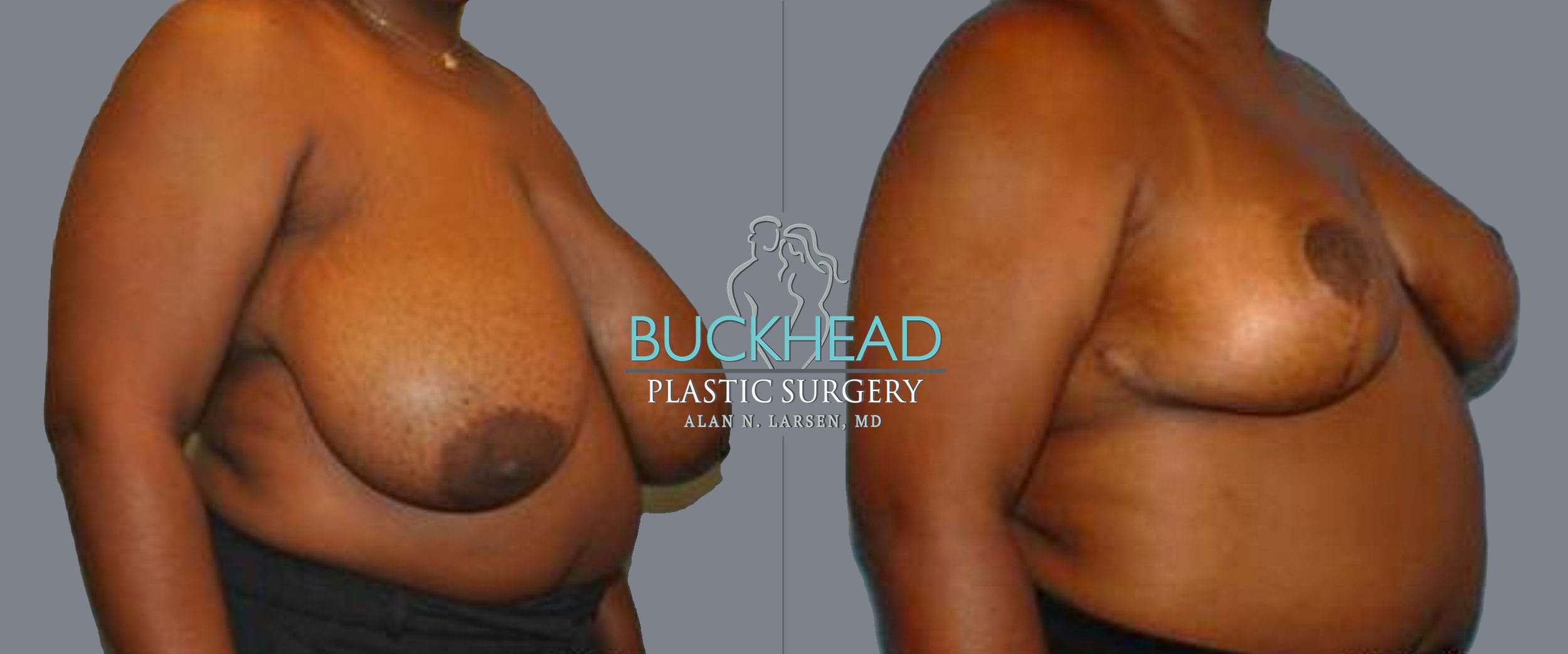 Before and After Photo Gallery | Breast Reduction | Buckhead Plastic Surgery | Alan N. Larsen, MD | Board-Certified Plastic Surgeon | Atlanta GA