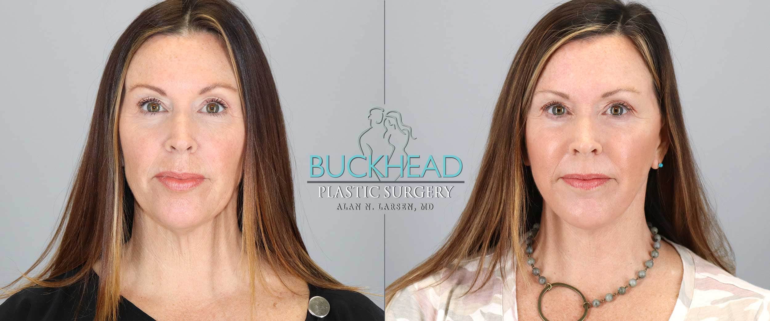 How-much-is-a-facelift-in-Atlanta_Buckhead-Plastic-Surgery_Feautred_Blog_CTA
