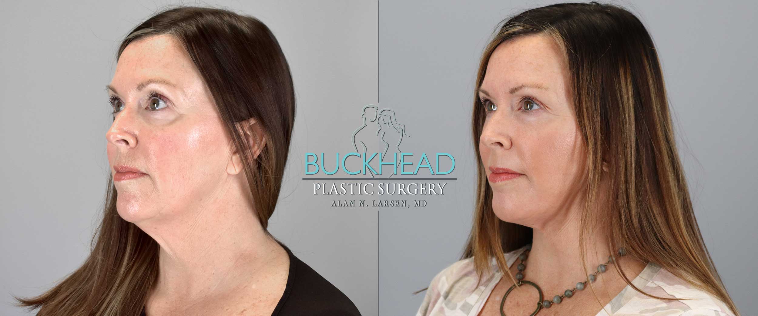 How-much-is-a-facelift-in-Atlanta_Buckhead-Plastic-Surgery_Feautred_Blog_CTA